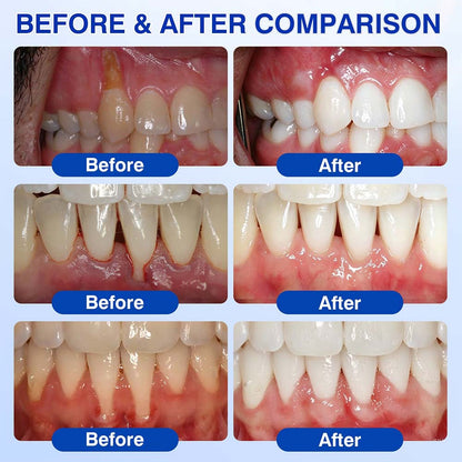 Healrize® GumRevive Periodontal Repair Gel (for bleeding gums, receding gums, and loose teeth)