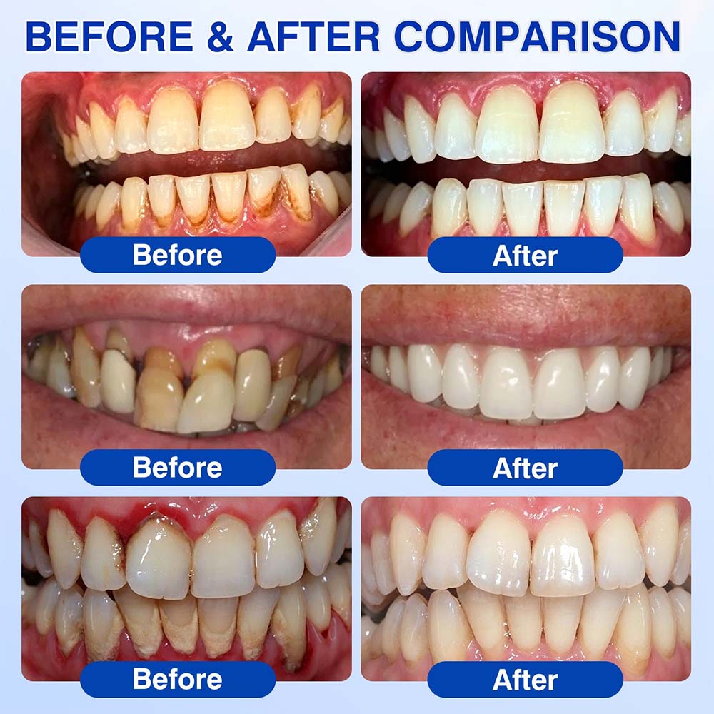 Healrize® GumRevive Periodontal Repair Gel (for bleeding gums, receding gums, and loose teeth)